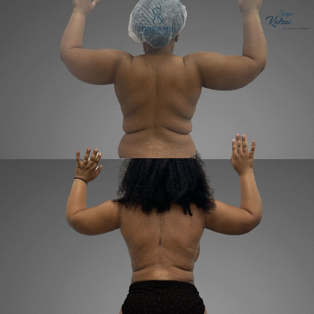Arm Lipo before and after result