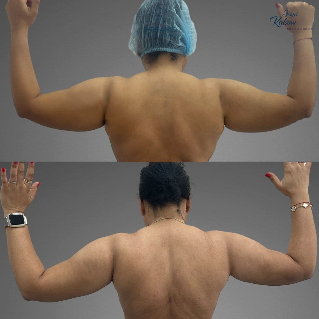 Arm liposuction before and after, back view