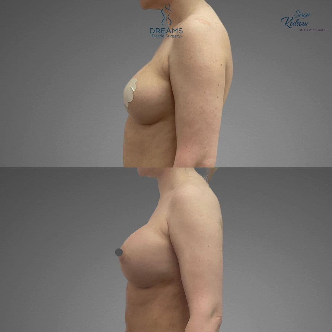 Awake Fat Transfer to Breast before and after result