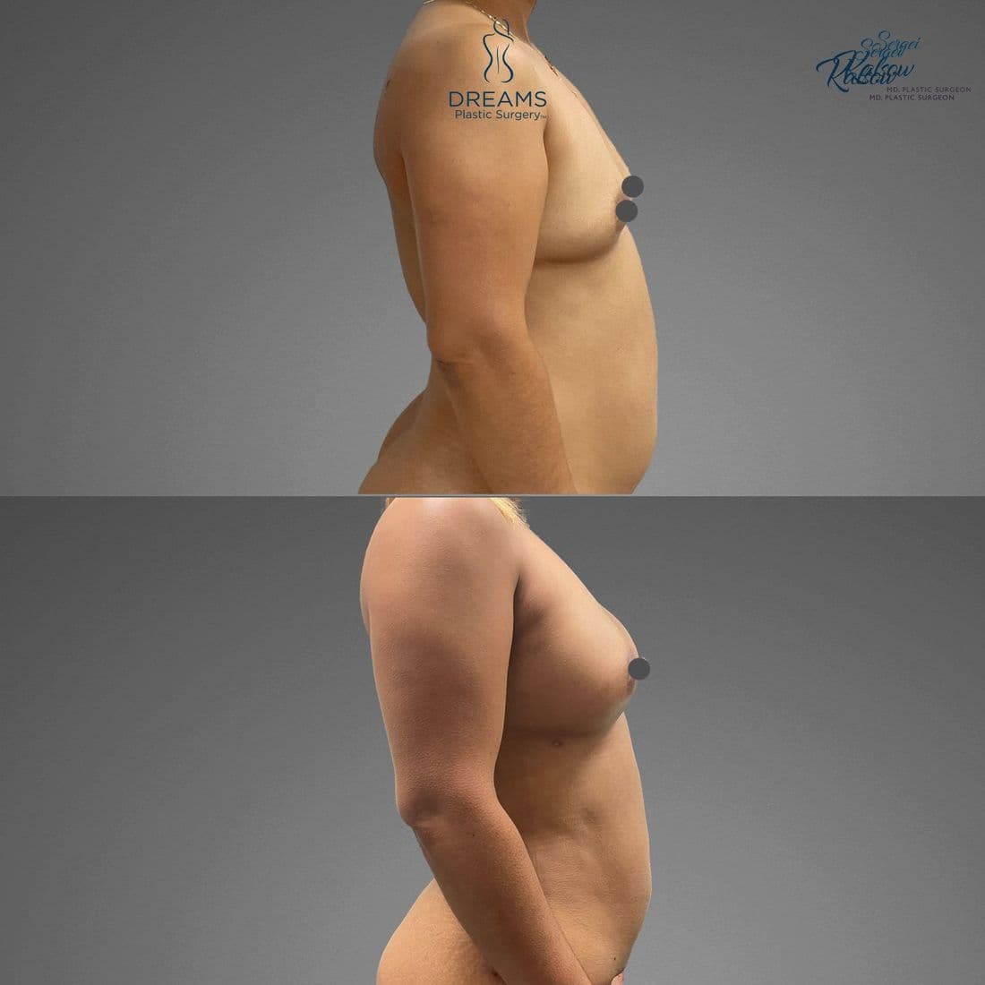 Awake fat transfer to breast before and after, profile view