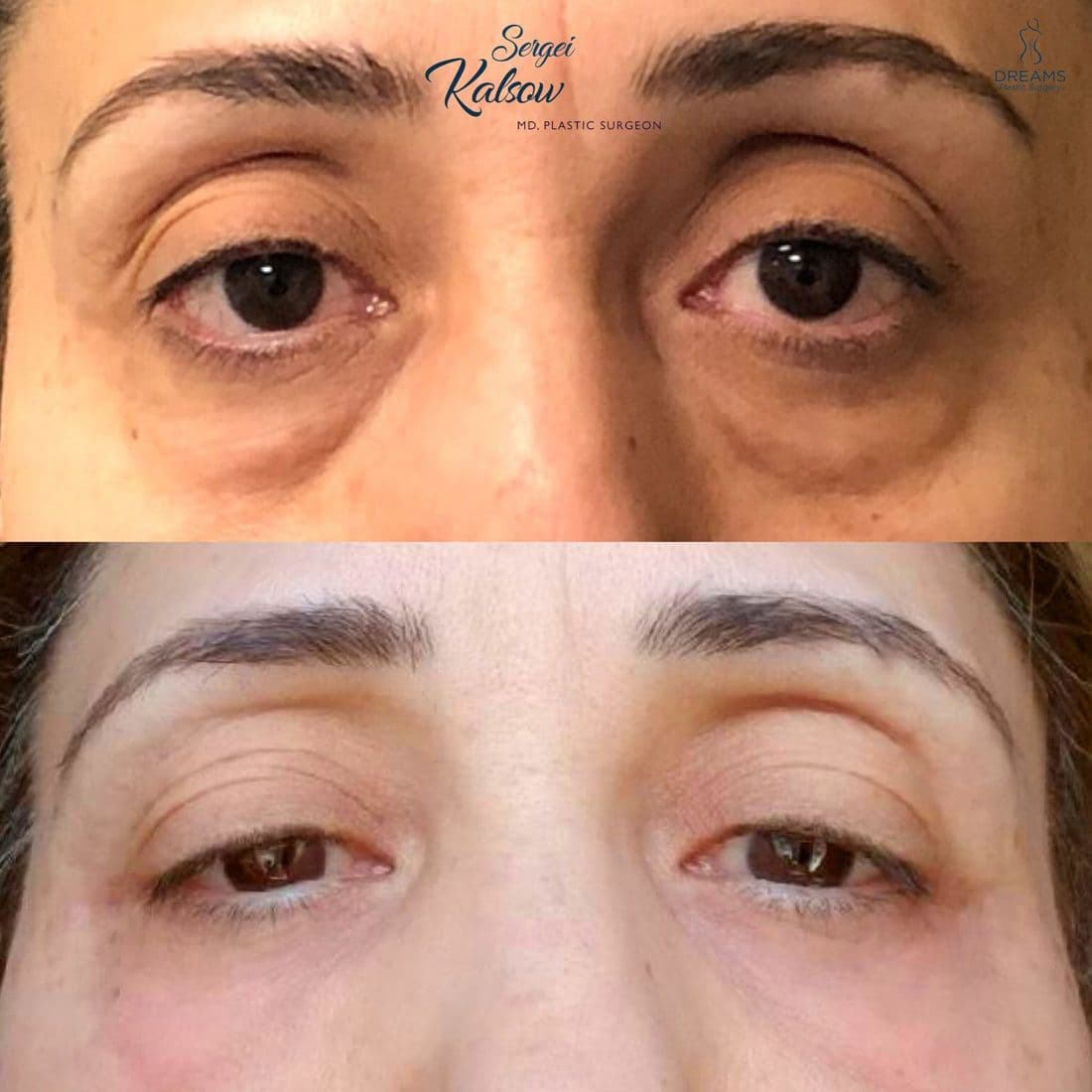 Blepharoplasty before and after result