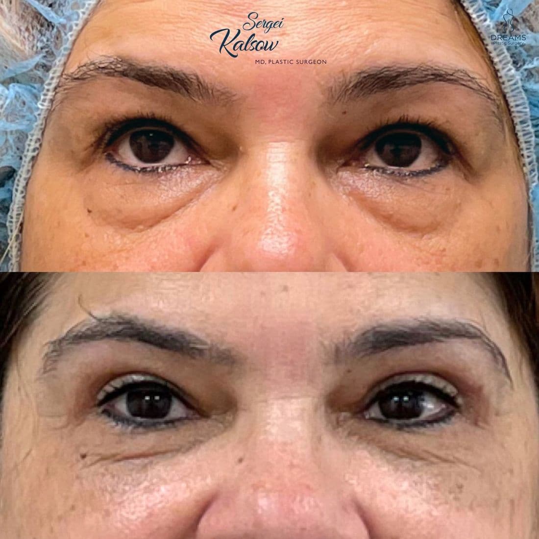 Blepharoplasty before and after, eyelid close-up