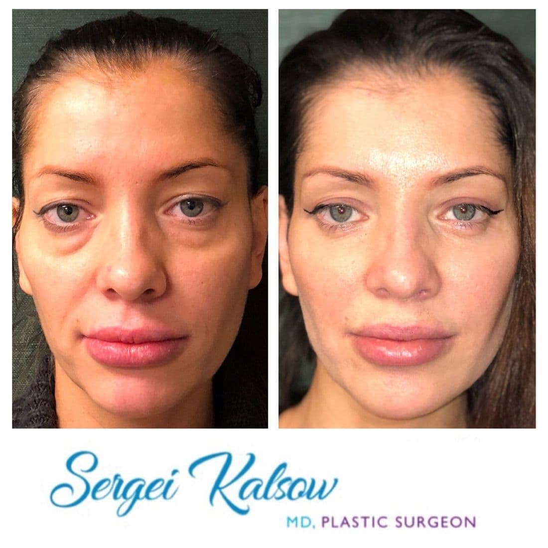 Blepharoplasty before and after, full face