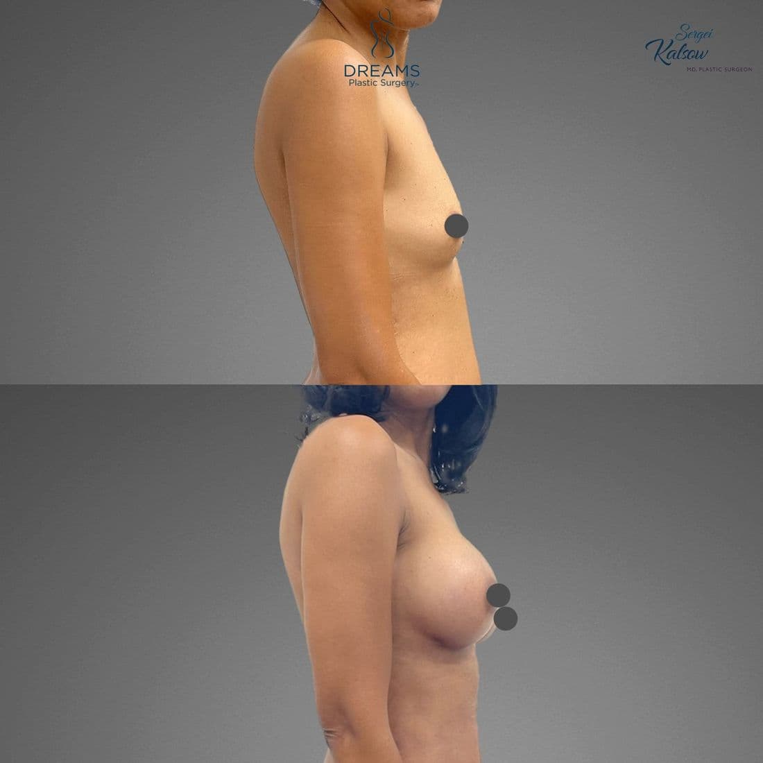 Breast Augmentation before and after result