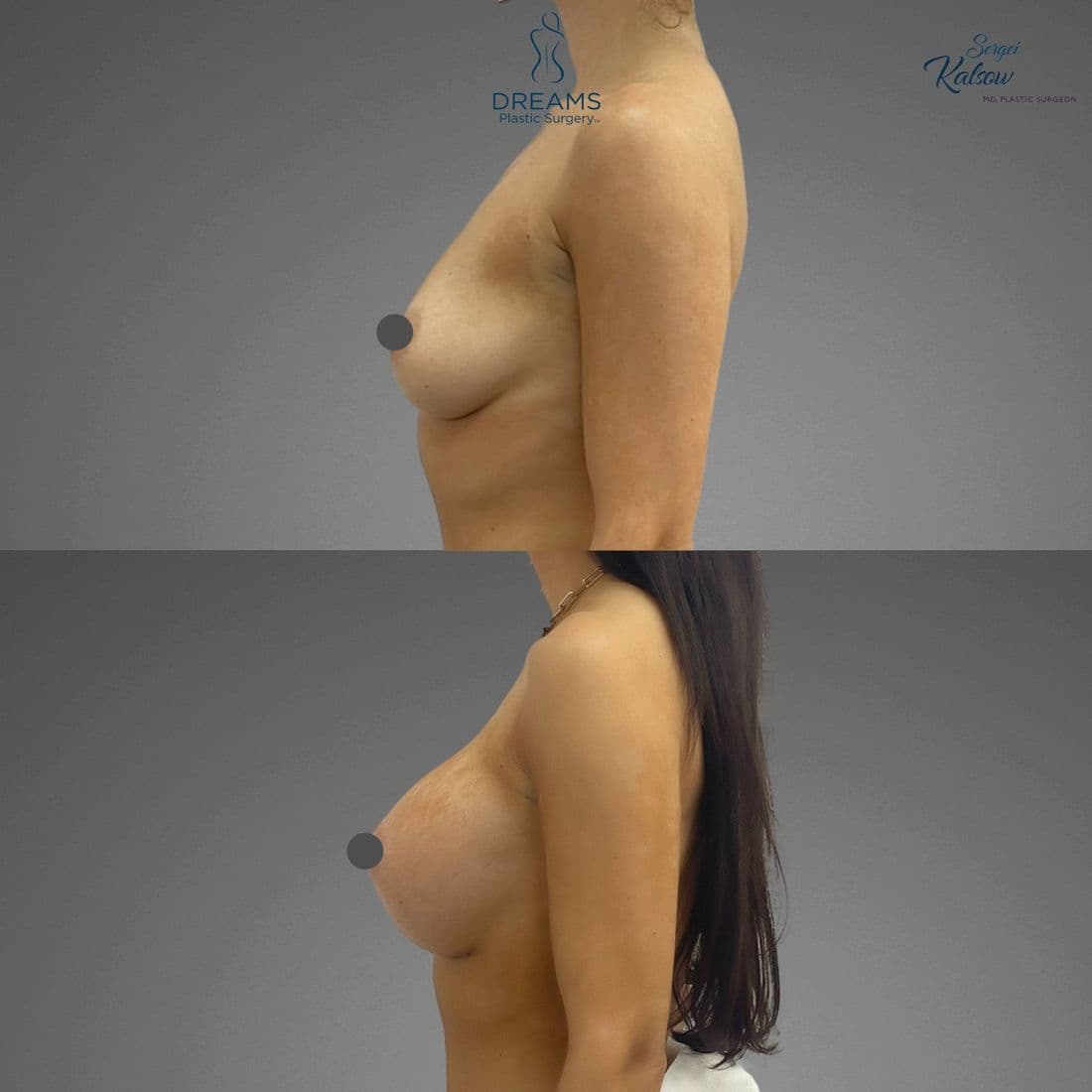 Breast augmentation before and after, profile view