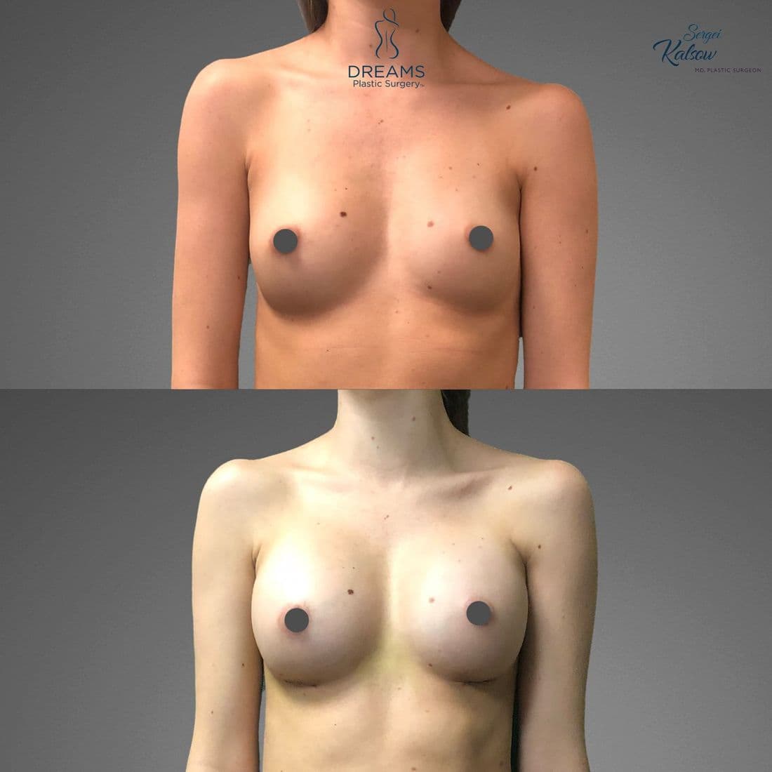 Breast augmentation before and after, front view