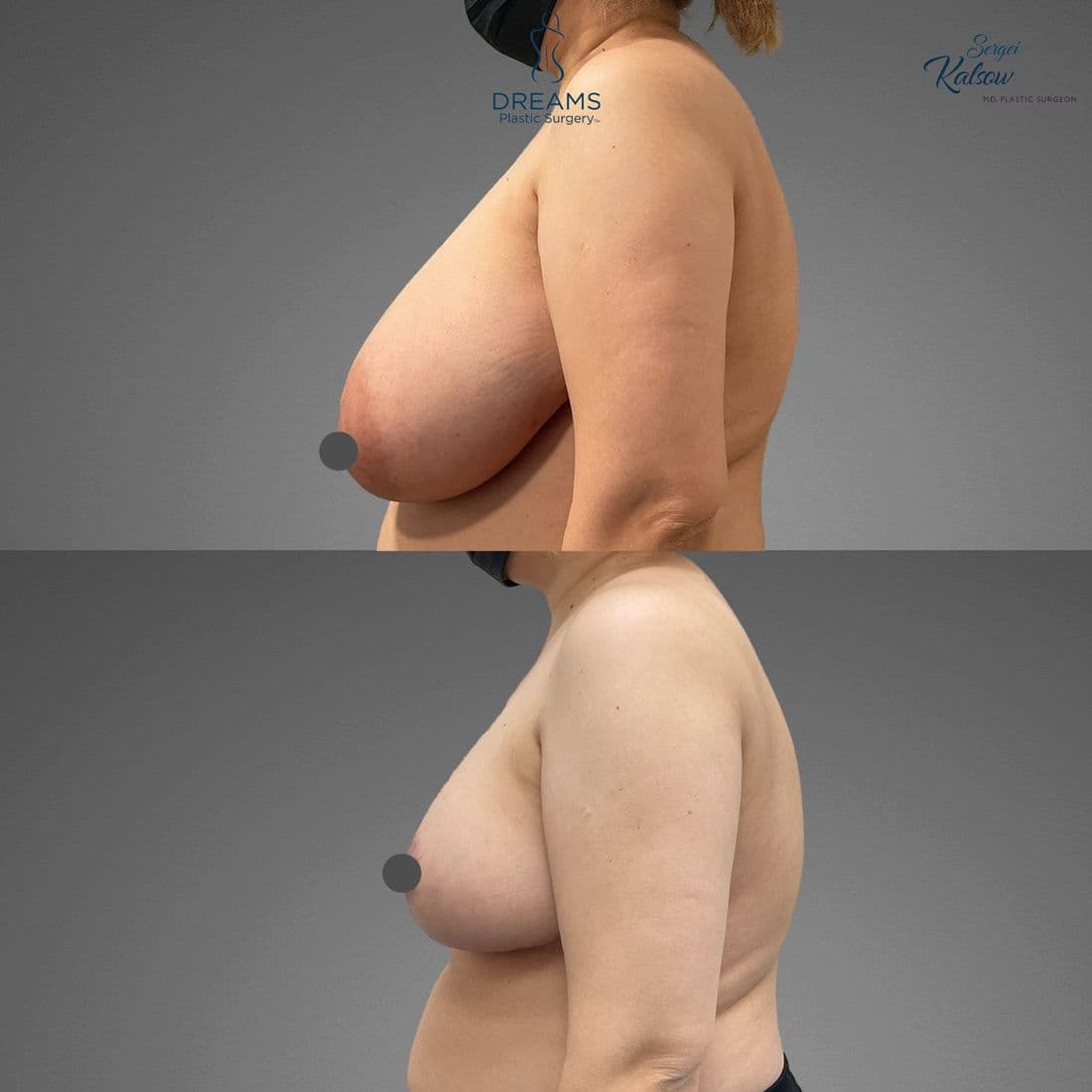 Breast Lift & Reduction before and after result