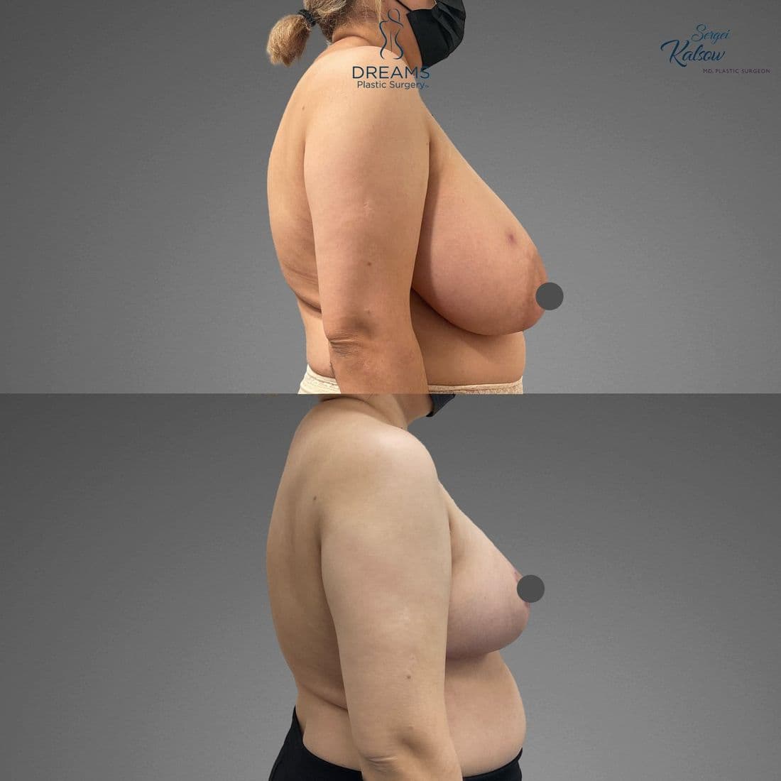 Breast lift and reduction before and after, profile view