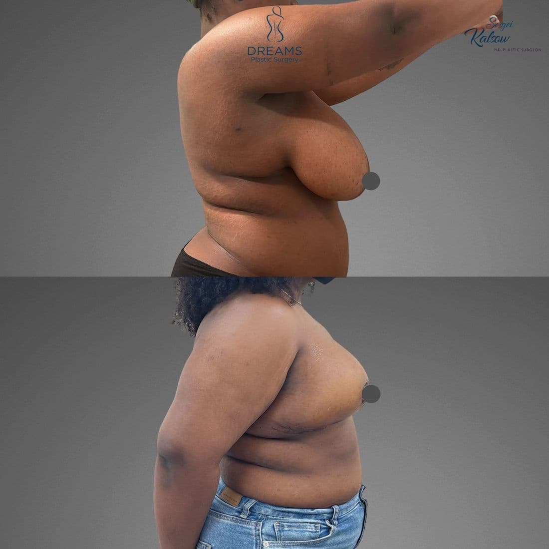 Breast lift and reduction before and after, profile view