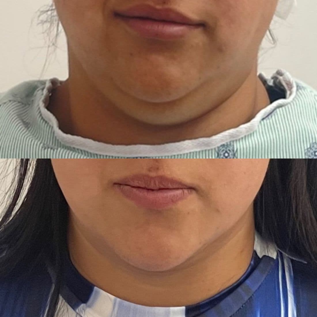 Chin liposuction before and after, front view