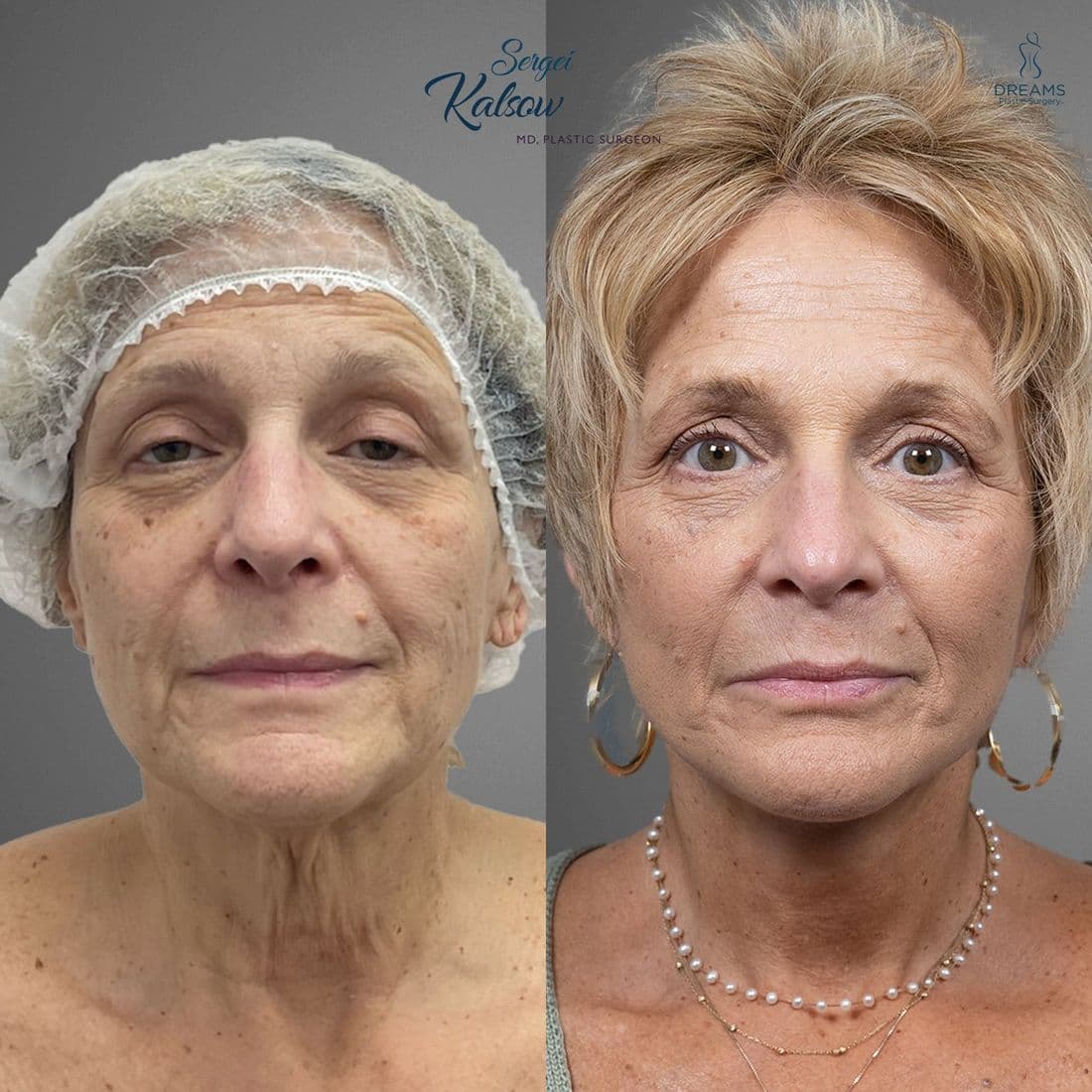 Facelift before and after result