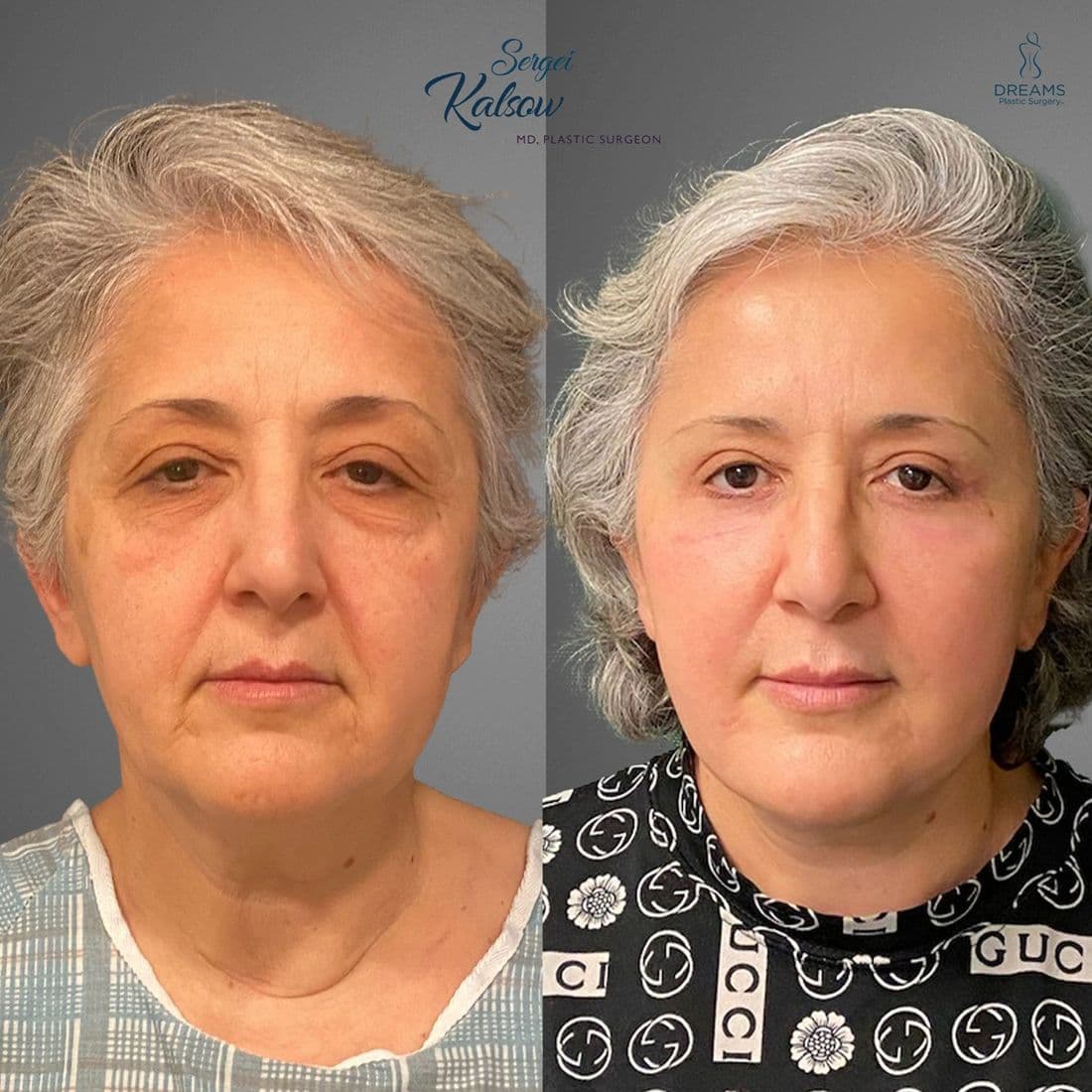 Facelift before and after, front view
