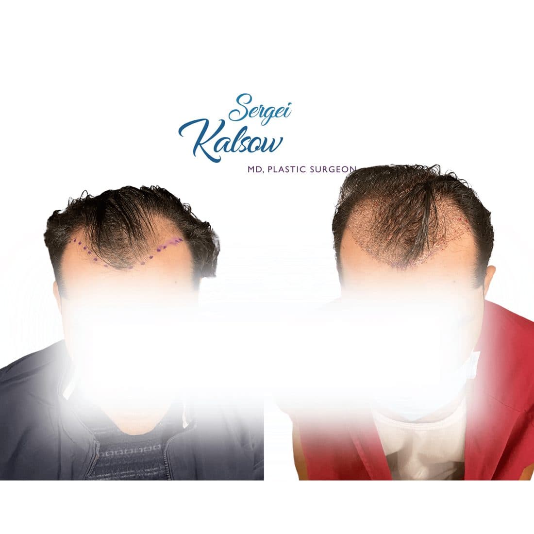 Hair transplant before and after, hairline