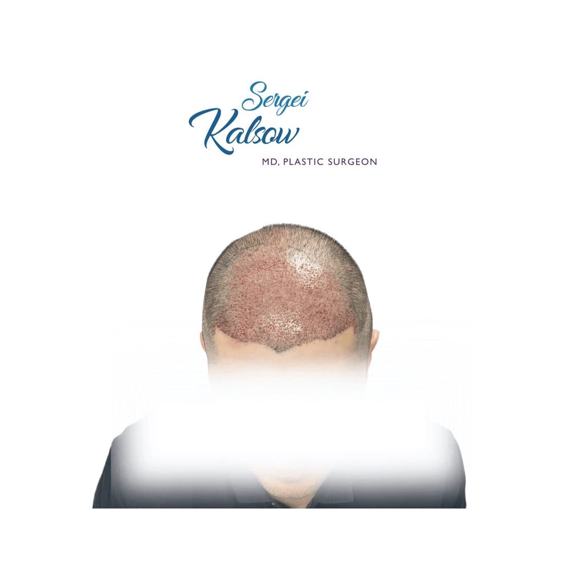 Grafted hairline immediately after a hair transplant