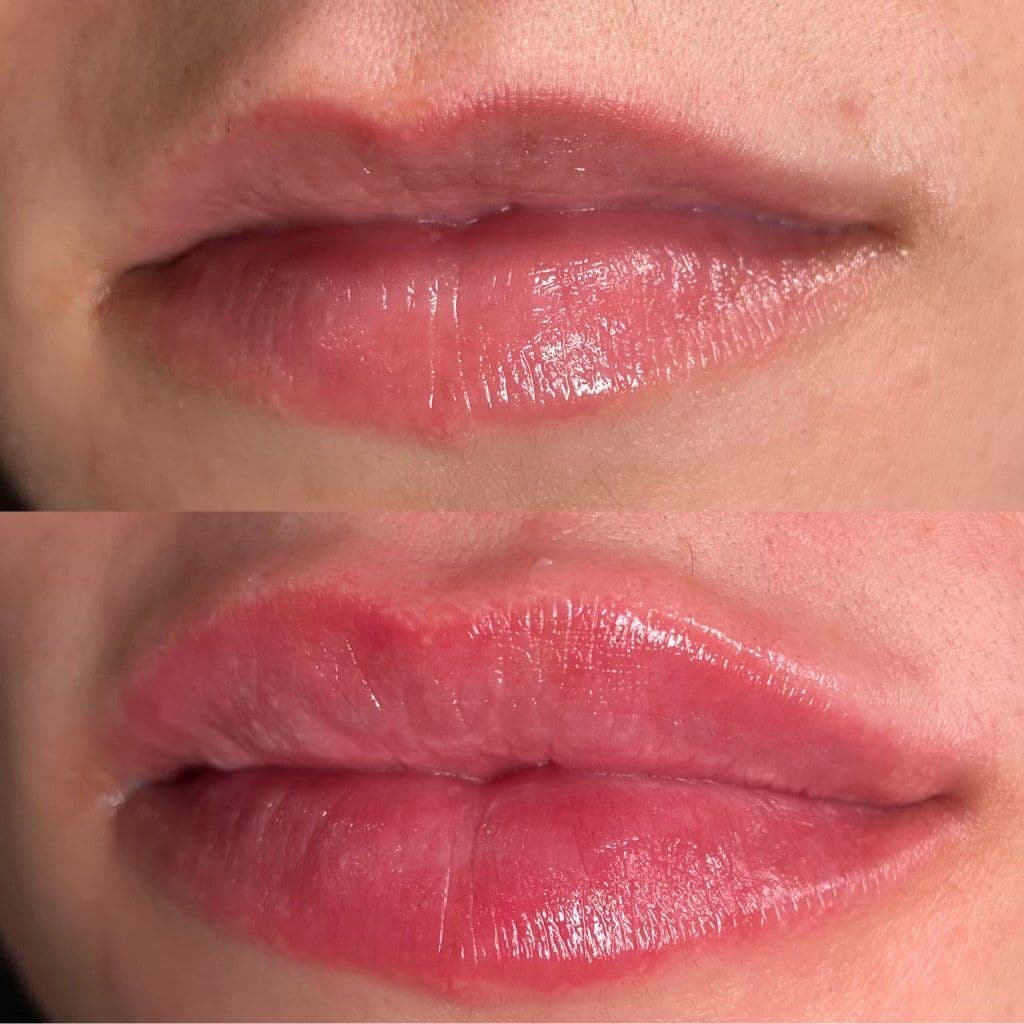 Lip Augmentation before and after result