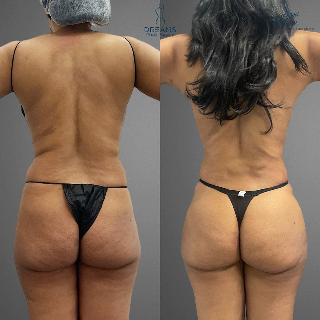 Lipo 360 and BBL before and after, back view