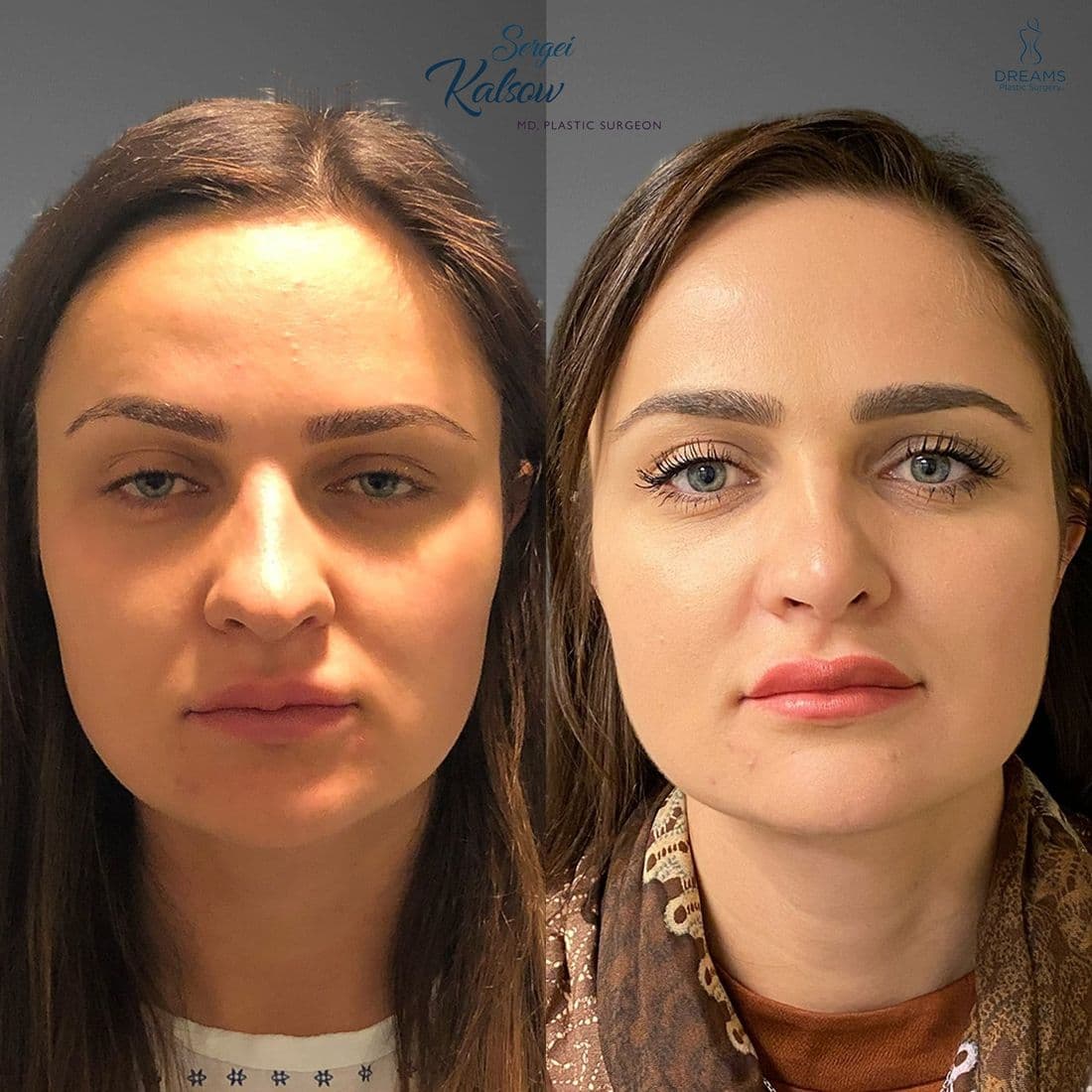 Rhinoplasty before and after result