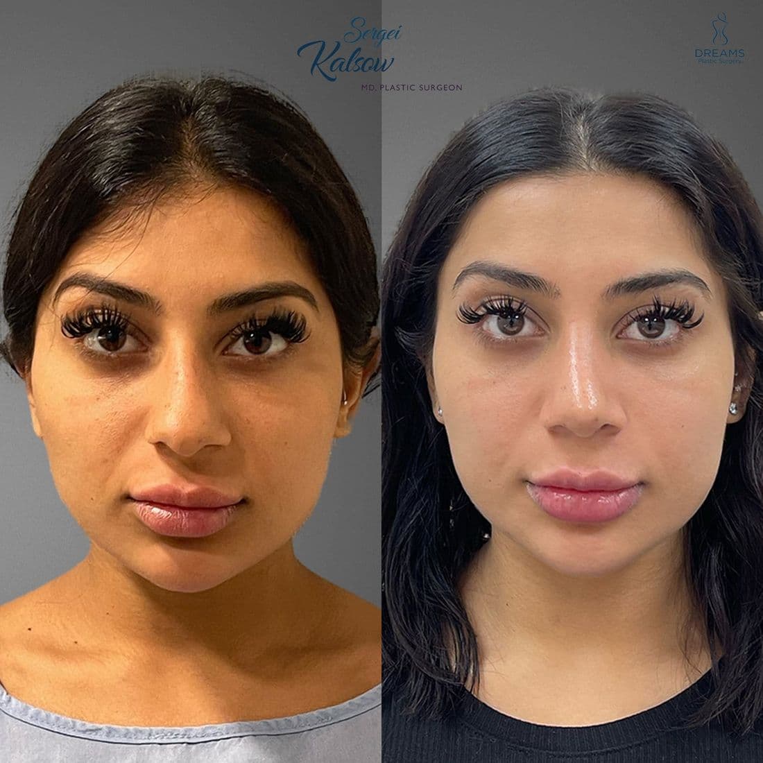 Rhinoplasty before and after, front view