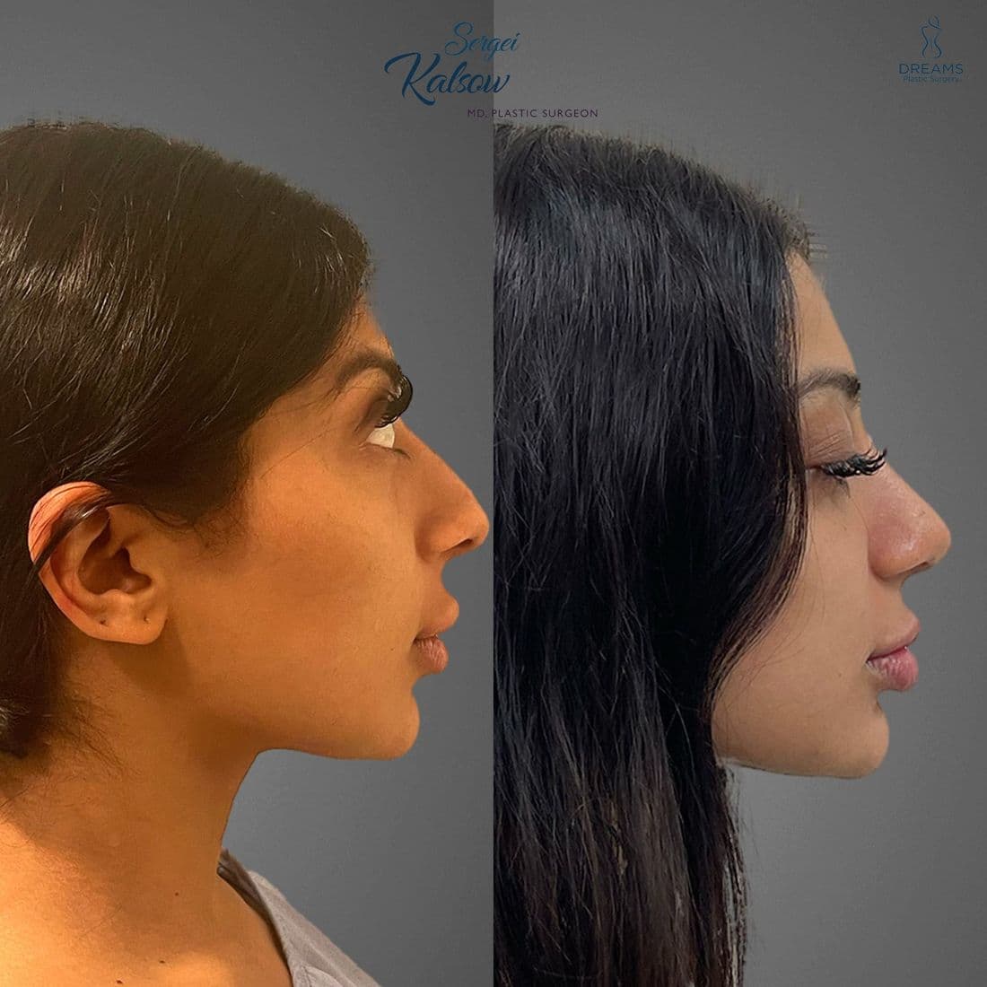 Rhinoplasty before and after, profile view
