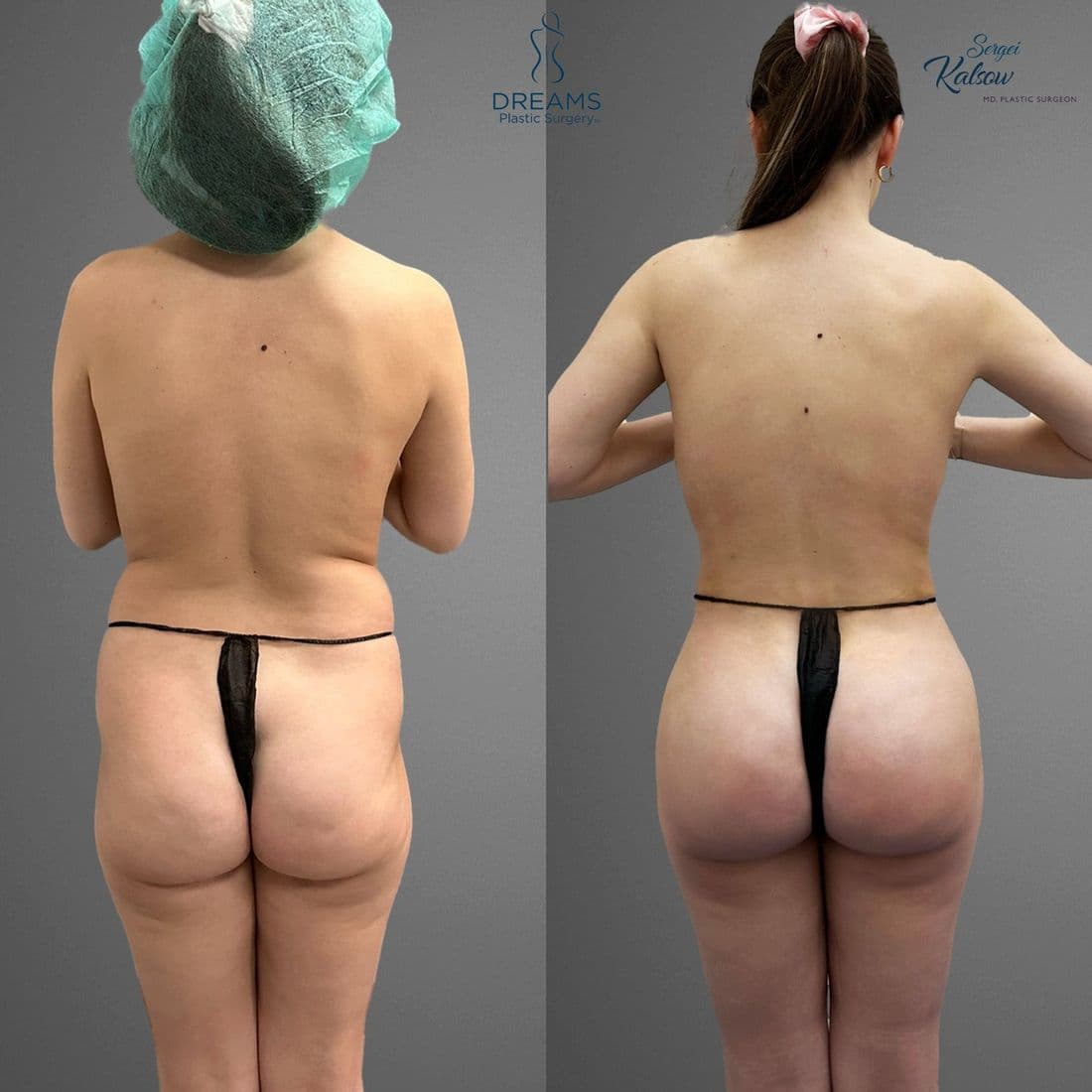 Skinny BBL before and after, back view