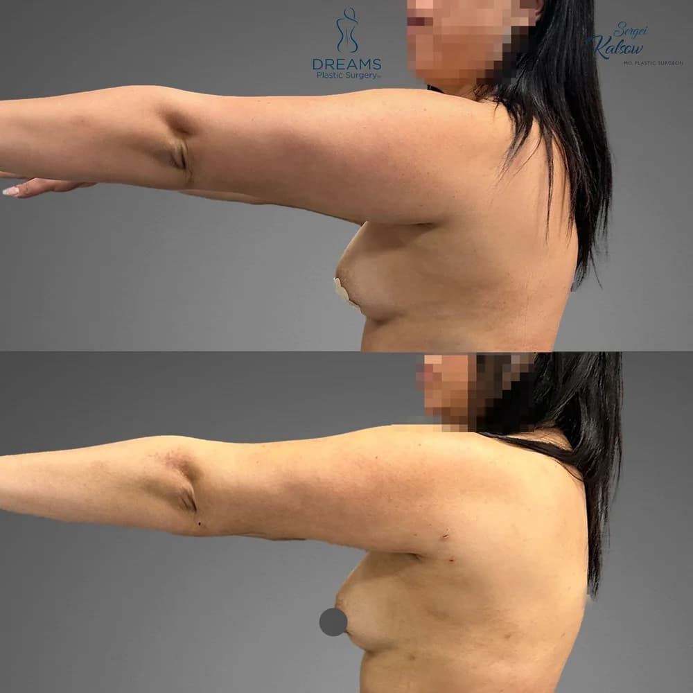 Arm Lipo before-and-after result, patient case 01