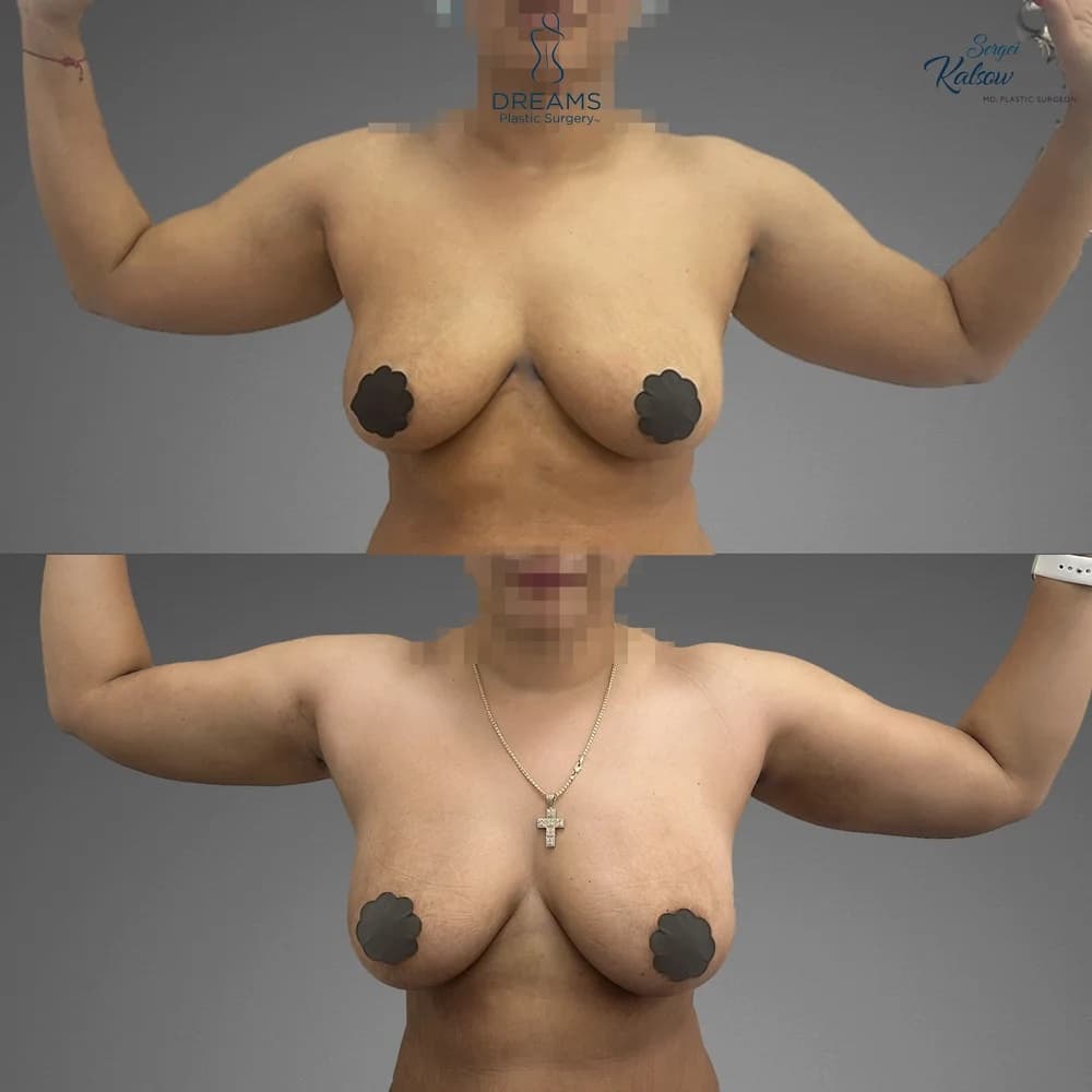 Arm Lipo before-and-after result, patient case 02