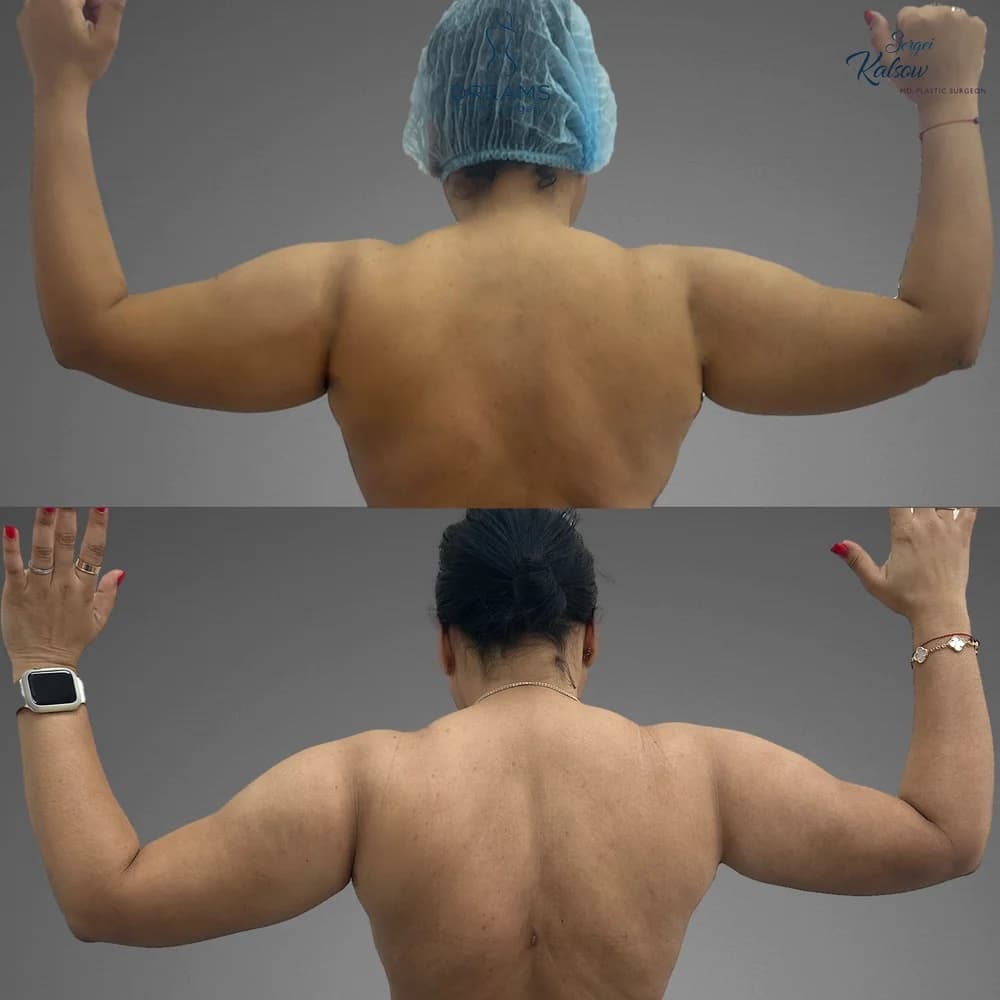 Arm Lipo before-and-after result, patient case 03