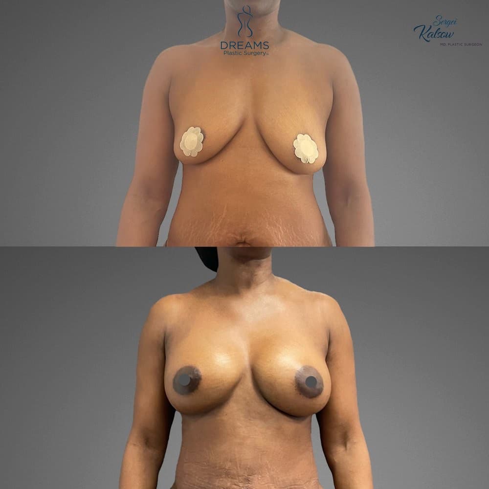 Awake Fat Transfer to Breast before-and-after result, patient case 01