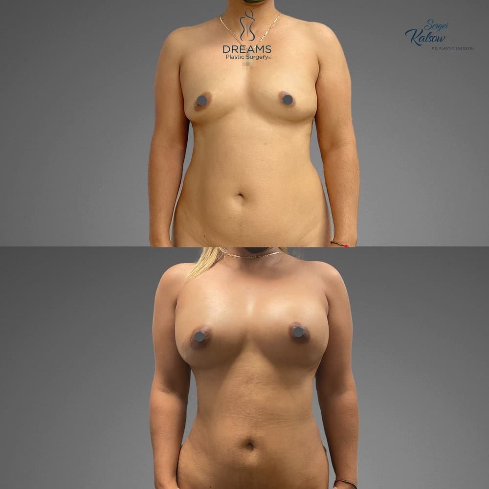 Awake Fat Transfer to Breast before-and-after result, patient case 02