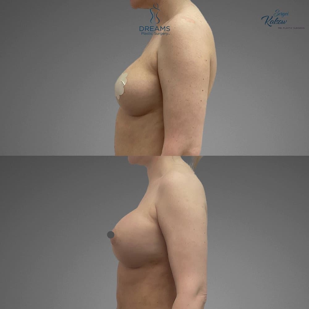Awake Fat Transfer to Breast before-and-after result, patient case 04