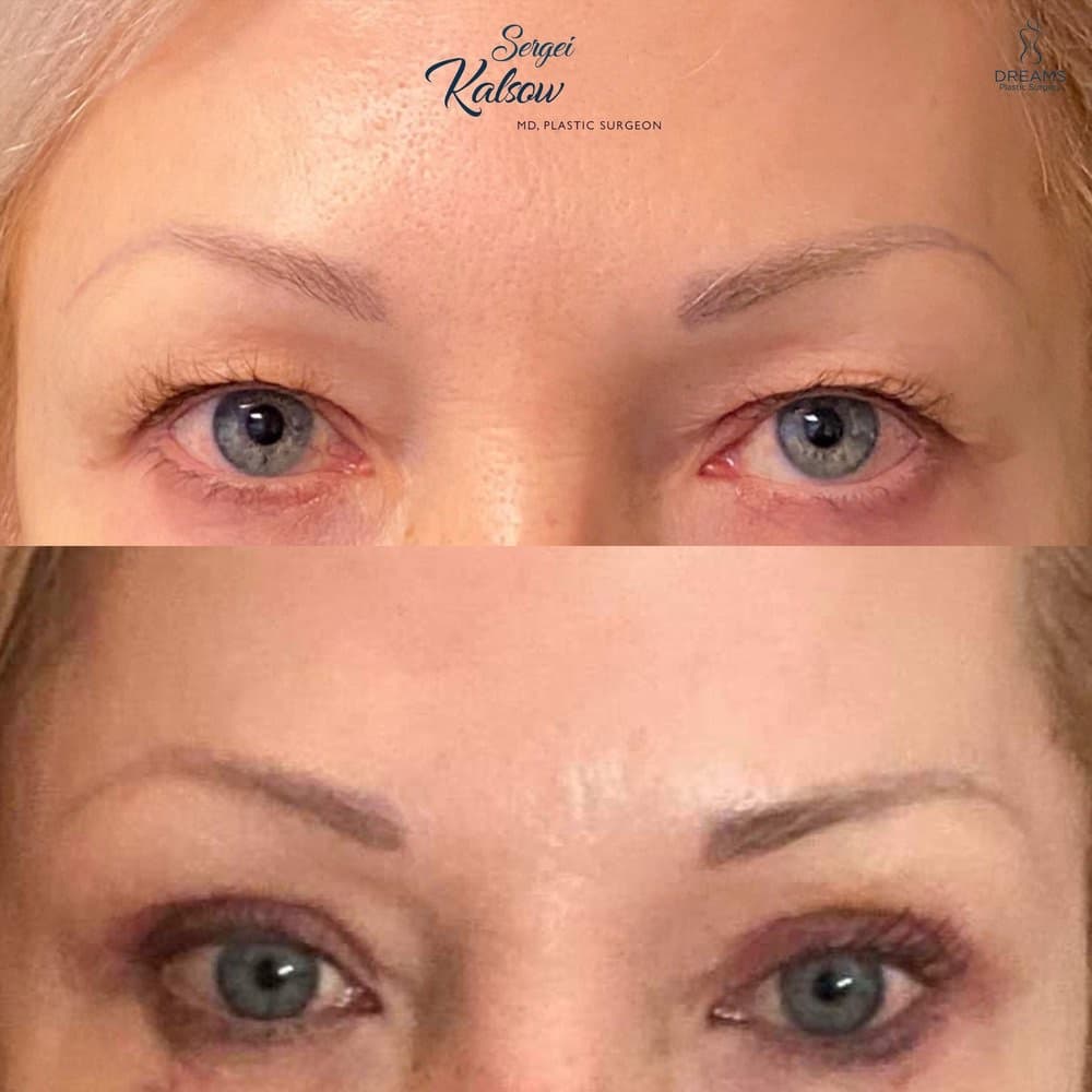 Blepharoplasty before-and-after result, patient case 01