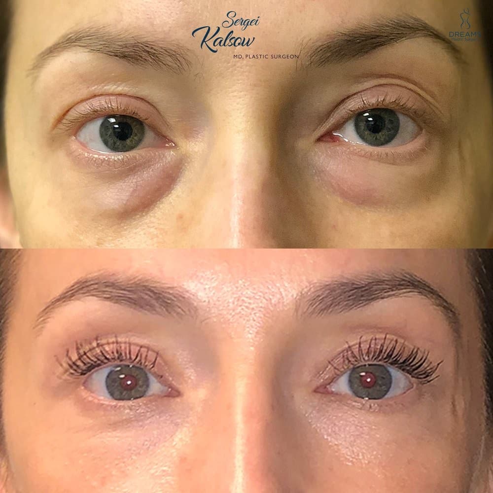 Blepharoplasty before-and-after result, patient case 02