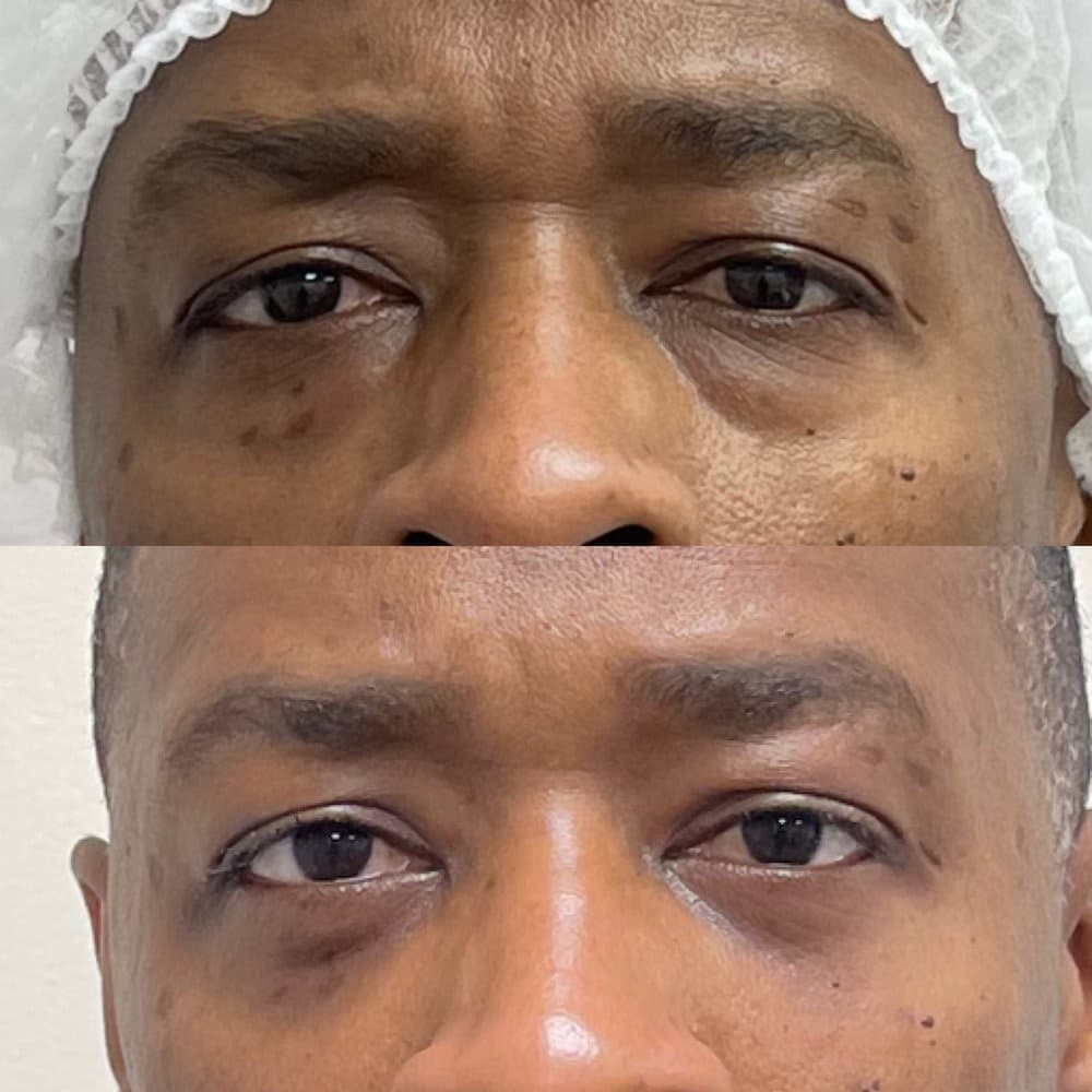 Blepharoplasty before-and-after result, patient case 03