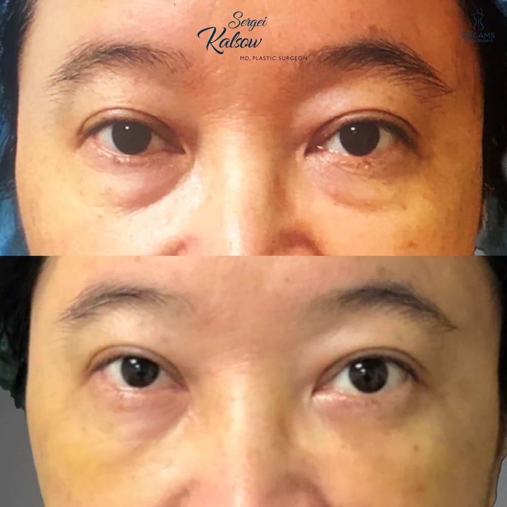 Blepharoplasty before-and-after result, patient case 04
