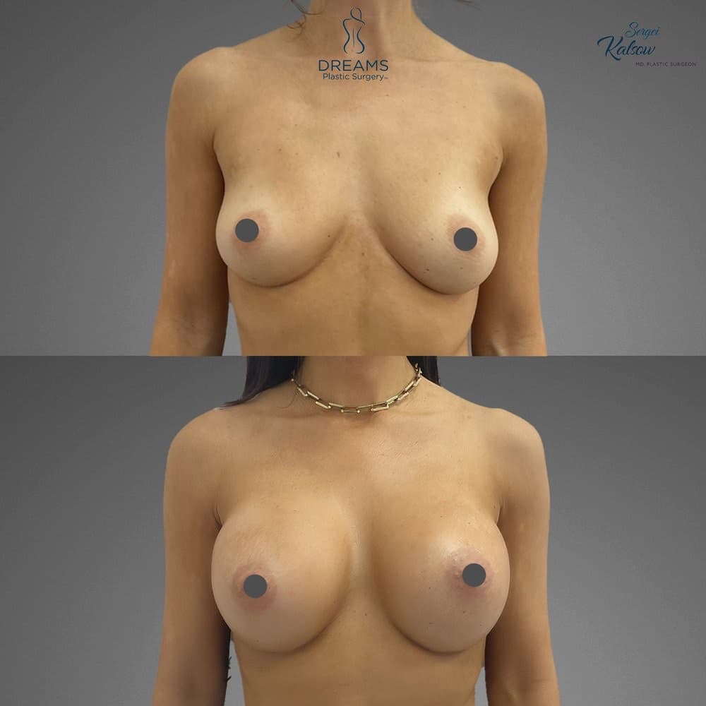 Breast Augmentation before-and-after result, patient case 03