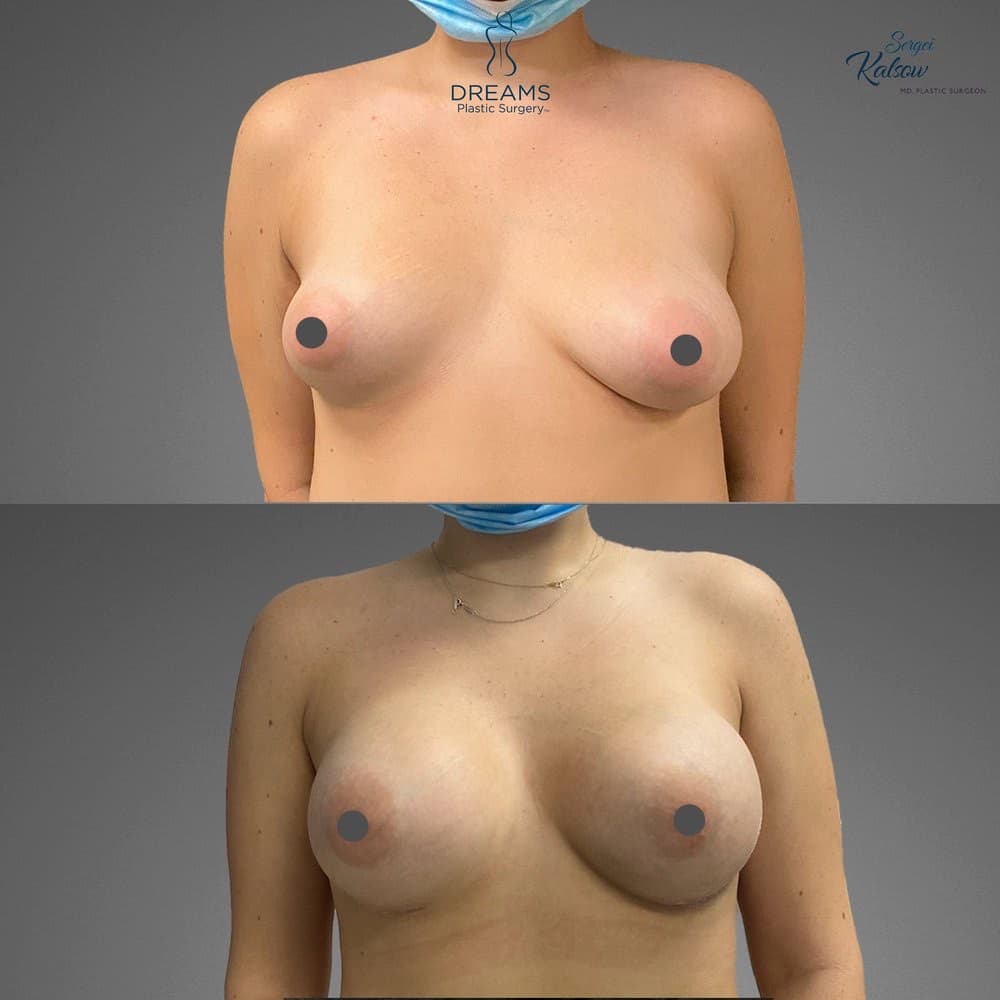 Breast Augmentation before-and-after result, patient case 04