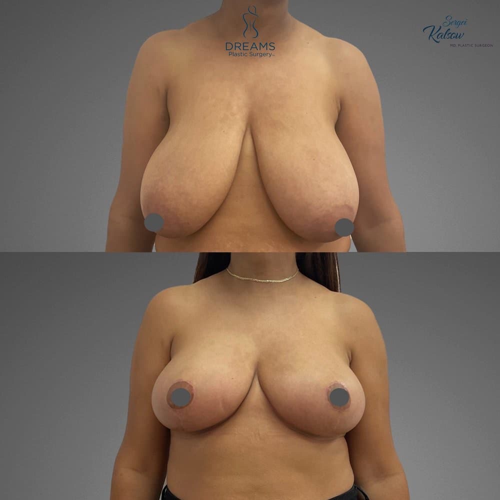 Breast Lift and Reduction before-and-after result, patient case 01