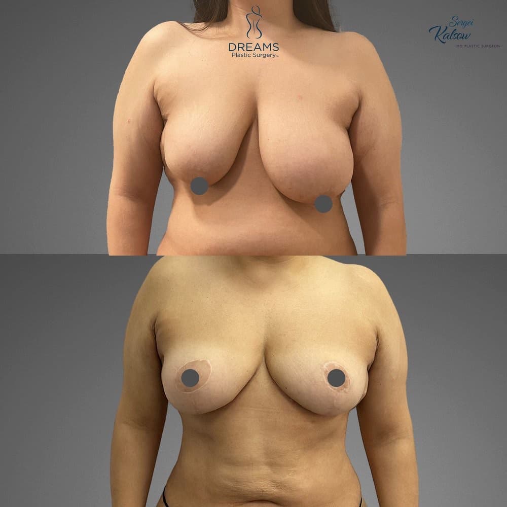 Breast Lift and Reduction before-and-after result, patient case 02
