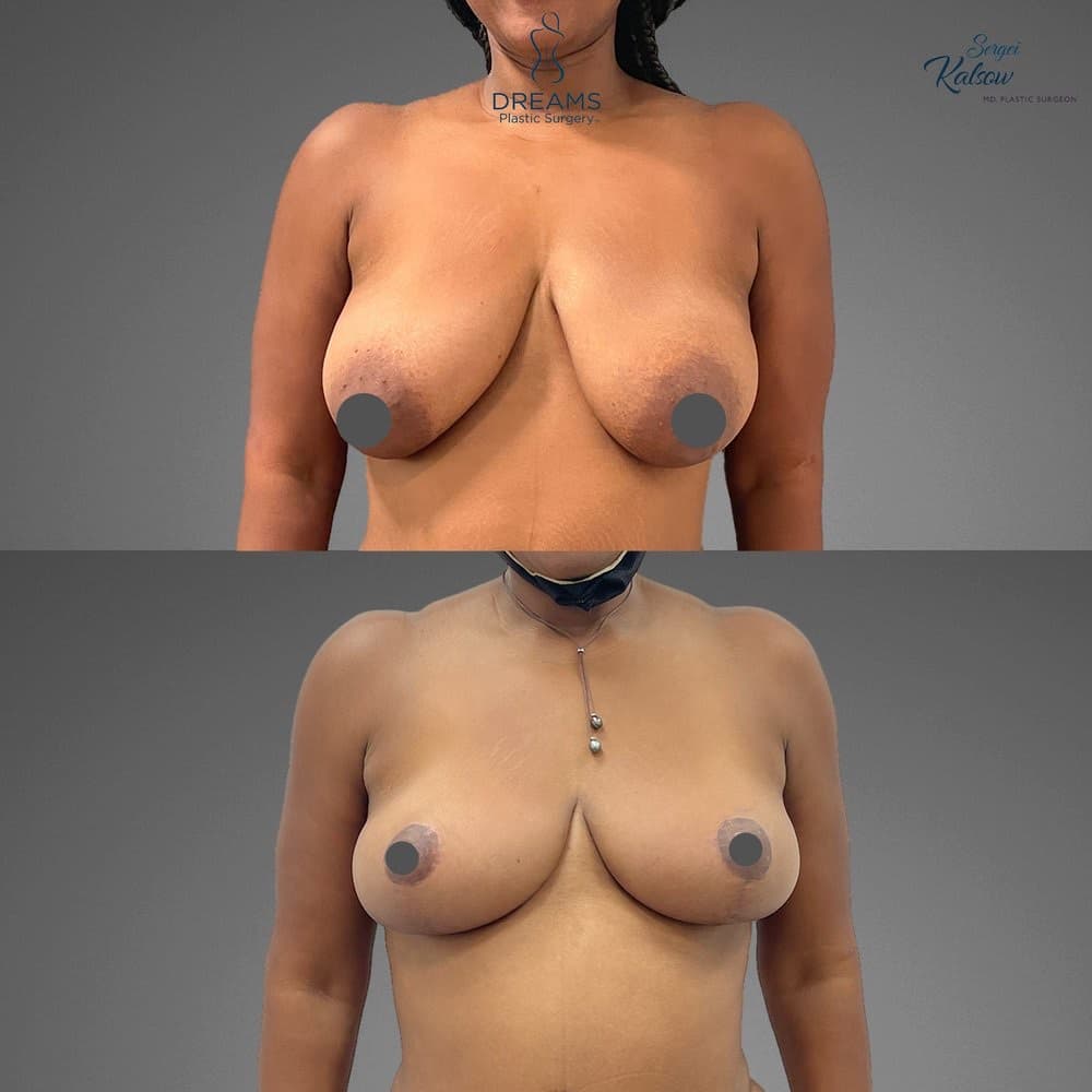 Breast Lift and Reduction before-and-after result, patient case 04