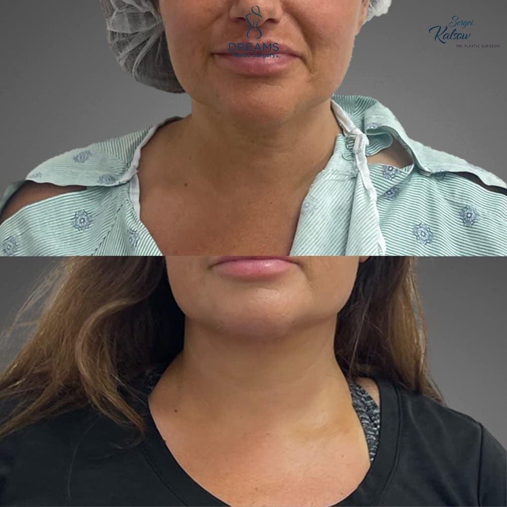 Chin Lipo before-and-after result, patient case 01