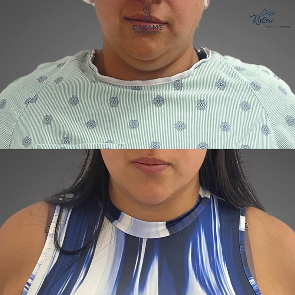 Chin Lipo before-and-after result, patient case 02