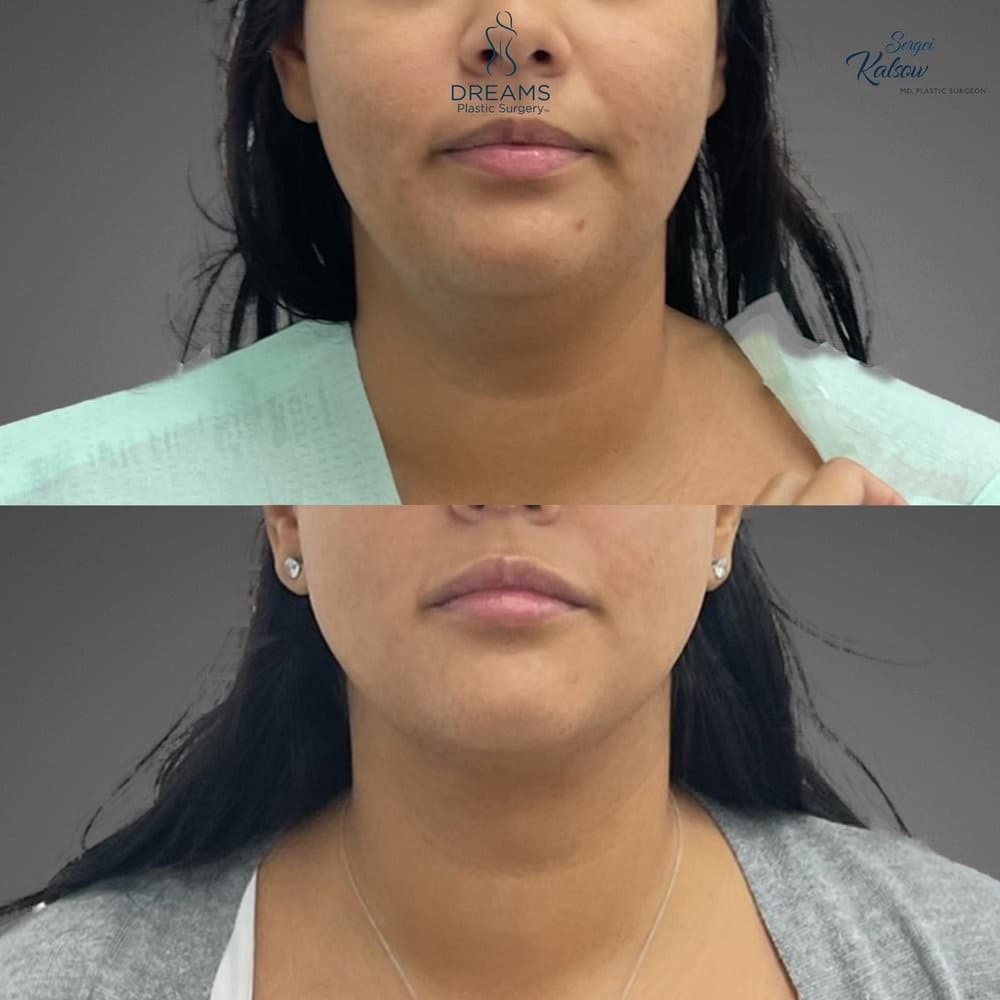 Chin Lipo before-and-after result, patient case 03
