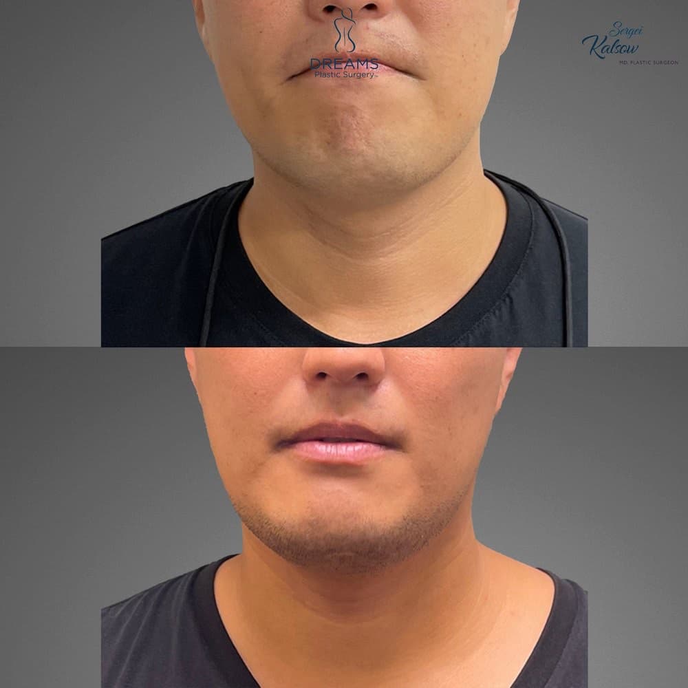 Chin Lipo before-and-after result, patient case 04