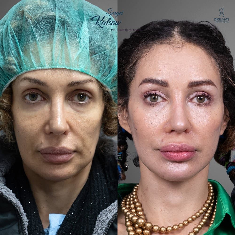 Facelift before-and-after result, patient case 02