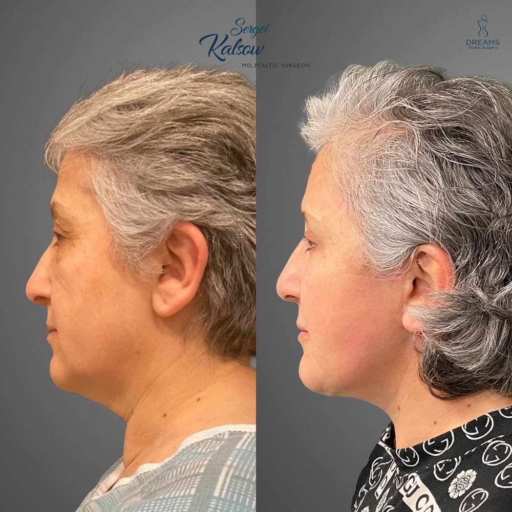 Facelift before-and-after result, patient case 03