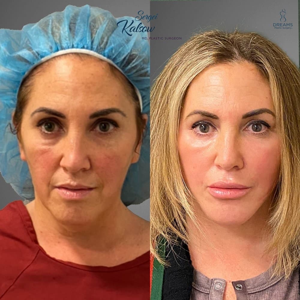 Facelift before-and-after result, patient case 04