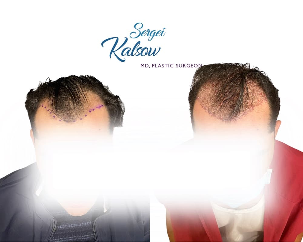 Hair Transplant before-and-after result, patient case 01