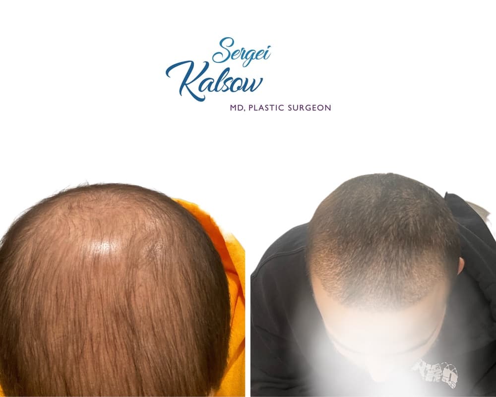 Hair Transplant before-and-after result, patient case 02