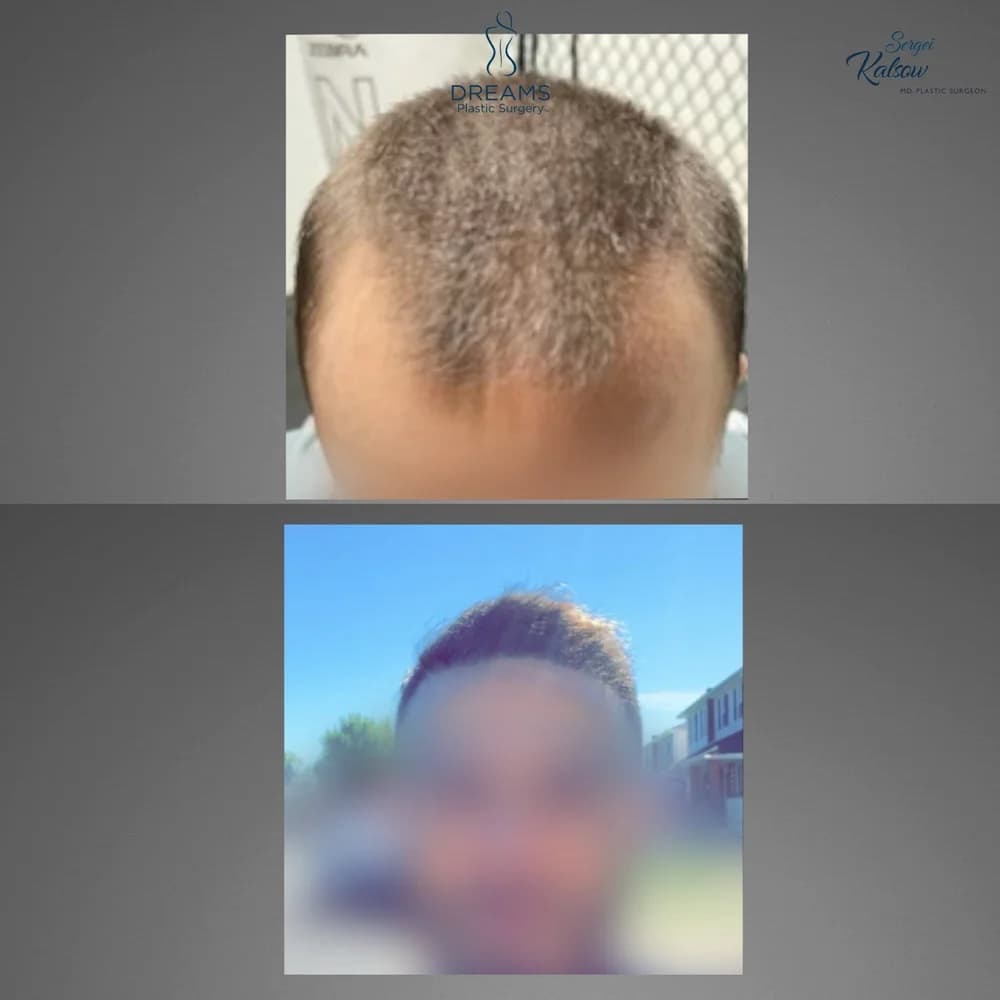 Hair Transplant before-and-after result, patient case 03