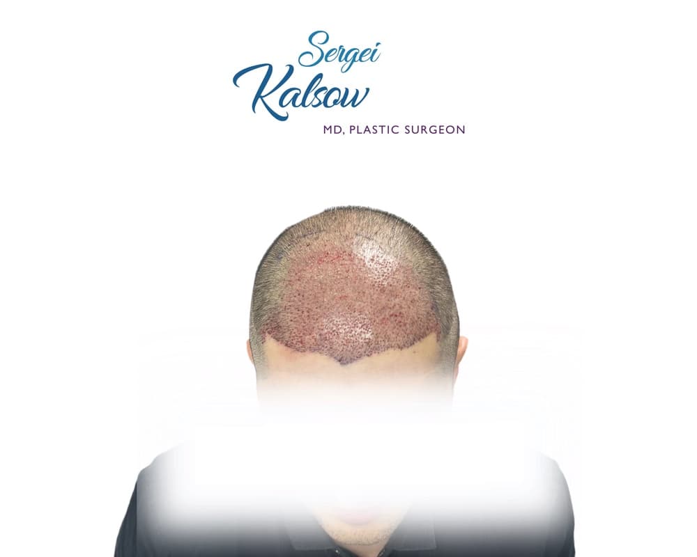 Hair Transplant before-and-after result, patient case 04